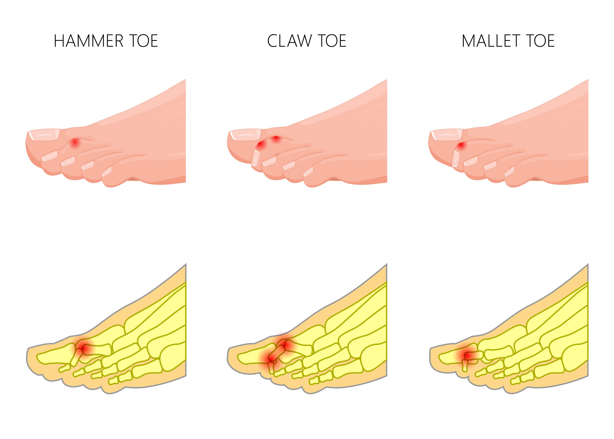 post_titleUnderstanding Hammer Toe Causes and How To Treat It
